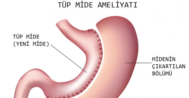 Tüp Mide (Sleeve Gastroctemy) Ameliyatı Nedir?